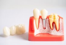 Straumann Roxolid: Material de noua generatie pentru implanturi de durata straumannroxolid_materialdenouageneratiepentruimplanturidedurata